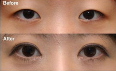 压双眼皮效果
