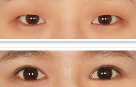 压双眼皮多久能洗澡