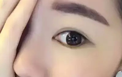 割眼袋几天恢复
