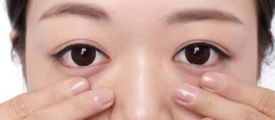 去眼袋后多久消肿