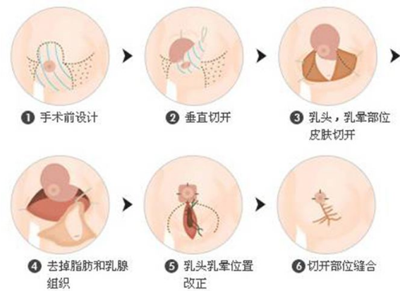 怎么把胸部变小