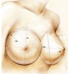 我想做乳房缩小，可以不做手术吗?