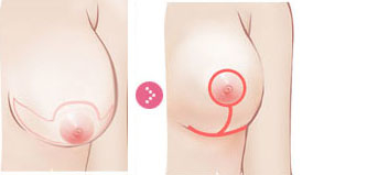 巨乳缩小手术有什么并发症