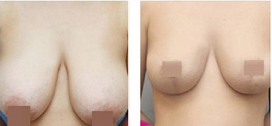 巨乳缩小术后注意事项有哪些