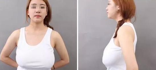 深圳做巨乳缩小手术一般多少钱