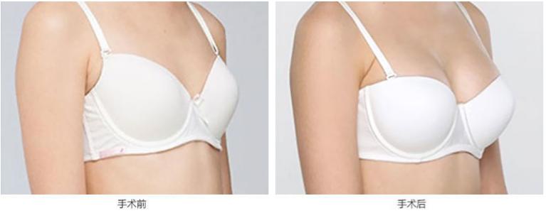 巨乳缩小前后对比图