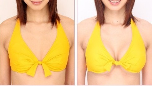 巨乳缩小术有后遗症吗？后遗症可能有哪些