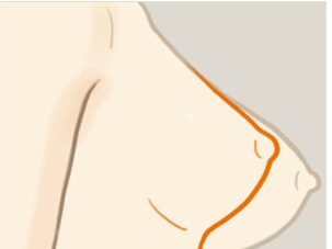 巨乳缩小术影响哺乳吗？效果好吗