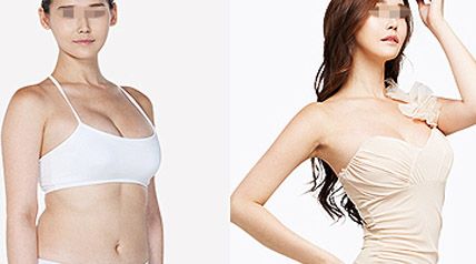 巨乳缩小手术方式，术后恢复过程