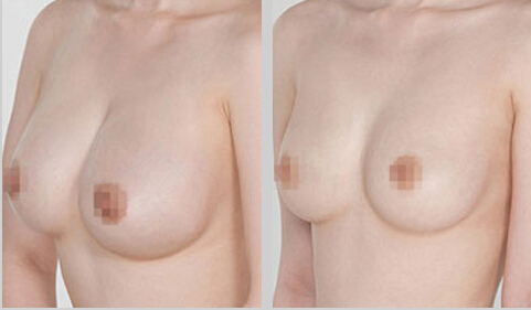 巨乳缩小术的矫正方式及效果