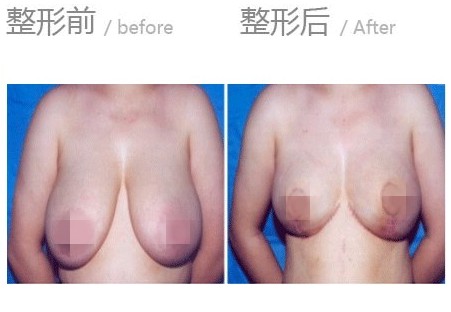 巨乳缩小术的术前准备和术后护理