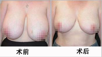 巨乳缩小术的安全与哪些因素有关