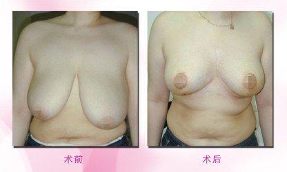 巨乳缩小术副作用及注意事项
