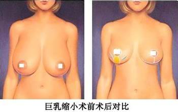 巨乳缩小术不适应人群有哪些