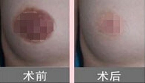乳晕缩小手术效果好吗