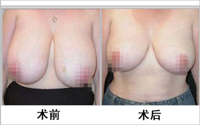 乳缩小手术可以做吗
