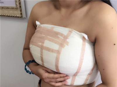 乳房缩小术案例恢复对比效果