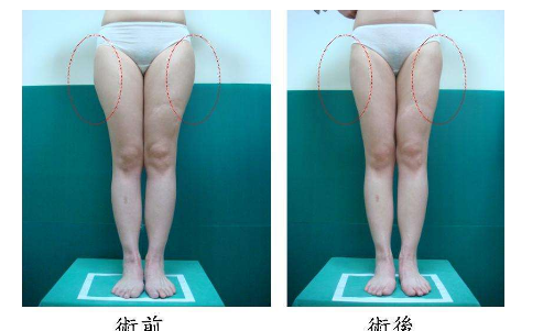 大腿环形抽脂的后遗症