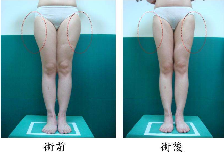 怎么去大腿脂肪