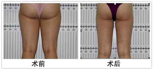 大腿环吸有什么危害