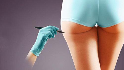 大腿吸脂多久可以运动