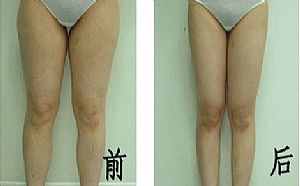 做完大腿抽脂要住院么