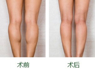 进口瘦脸注射瘦腿多少钱一支		