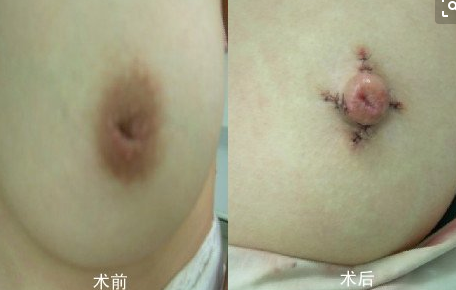 乳头凹陷有什么影响