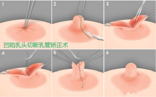 如何治疗乳头内陷