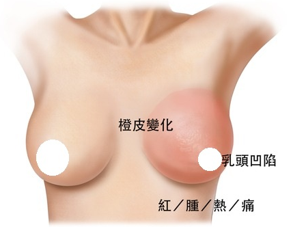 女性乳头凹陷的原因与危害