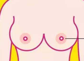 为什么会乳头内陷