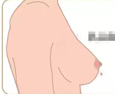 不同程度的乳头凹陷相应的采取的方法有哪些