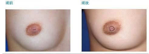 乳头凹陷分类都有哪些呢？