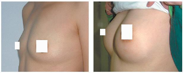 怎么才能防止乳头内陷