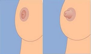 贵州乳头内陷的注意事项有哪些