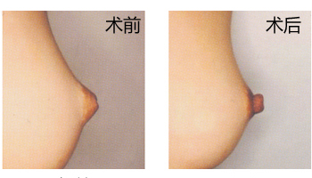 介绍：乳头凹陷矫正会反弹吗？