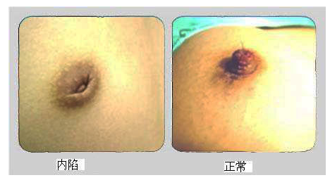 介绍乳头凹陷分类都有哪些呢？
