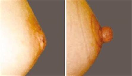 如何避免乳头凹陷的危害