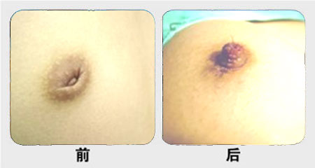 乳头凹陷矫正会反弹吗？