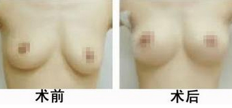 乳头矫正手术多少钱