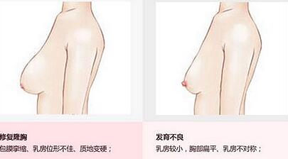 怎样可以丰胸增大