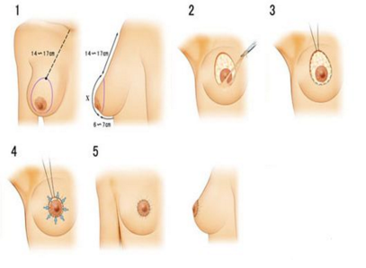 乳房大小不对称怎么办