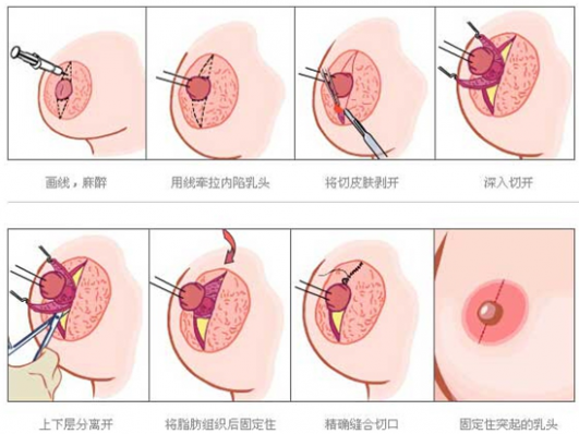 乳头整形失败的而出现情况有哪些
