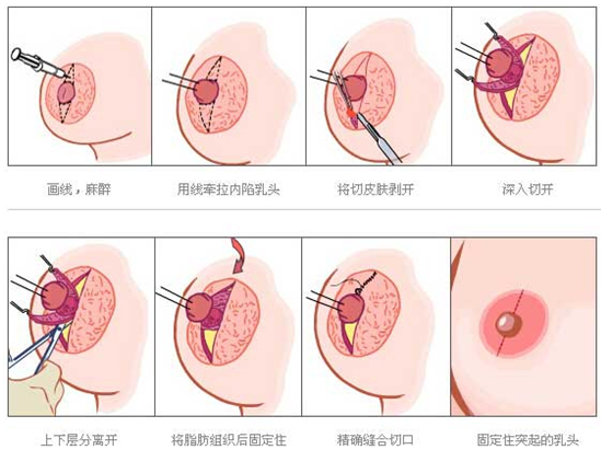 乳头整形失败的而出现情况有哪些