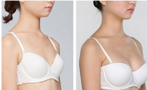 何时开始乳房再造