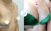 乳房不对称怎么办