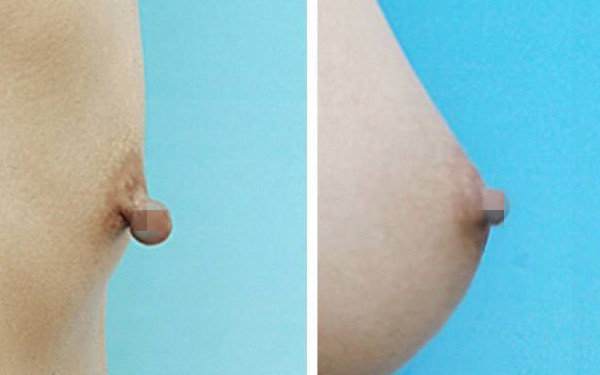 乳头矫正手术什么年龄好