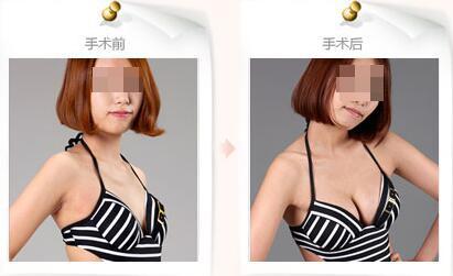 做了丰胸手术能摸吗