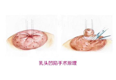 乳头内陷矫正术效果好吗