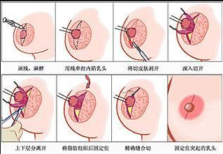 乳头内陷矫正多久消肿